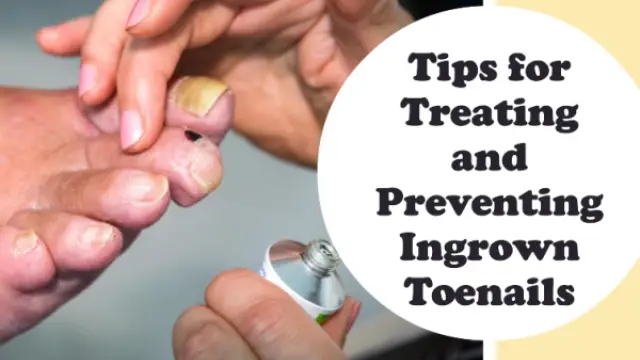 Help Your Feet Heal: Tips for Treating and Preventing Ingrown Toenails